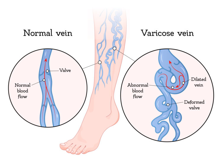 leg vein